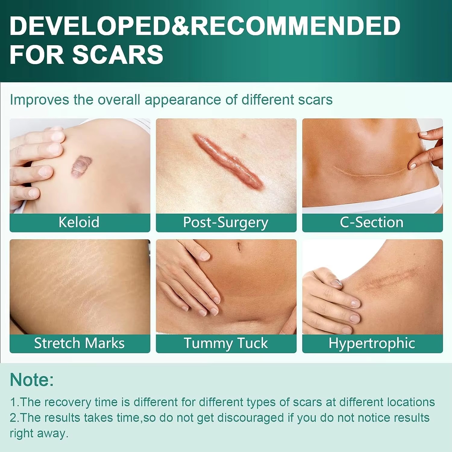 50/100/150cm Silicone Gel Scar - đánh giá và giá Medical Tape